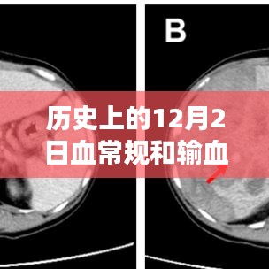 歷史上的12月2日，血常規(guī)與輸血技術(shù)的重大進(jìn)展與回顧