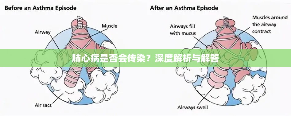 肺心病是否會傳染？深度解析與解答
